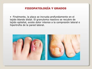 FISIOPATOLOGÍA Y GRADOS •  Finalmente, la placa se incrusta profundamente en el tejido blando distal. El granuloma reactivo se recubre de tejido epitelial, existe dolor intenso a la compresión lateral e hipertrofia de la pared lateral.  