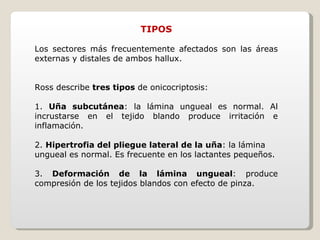 TIPOS Los sectores más frecuentemente afectados son las áreas externas y distales de ambos hallux. Ross describe  tres tipos  de onicocriptosis: 1.  Uña subcutánea : la lámina ungueal es normal. Al incrustarse en el tejido blando produce irritación e inflamación. 2.  Hipertrofia del pliegue lateral de la uña : la lámina ungueal es normal. Es frecuente en los lactantes pequeños. 3.  Deformación de la lámina ungueal : produce compresión de los tejidos blandos con efecto de pinza. 
