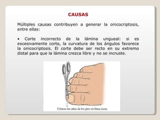 CAUSAS Múltiples causas contribuyen a generar la onicocriptosis, entre ellas: •  Corte incorrecto de la lámina ungueal: si es excesivamente corto, la curvatura de los ángulos favorece la onicocriptosis. El corte debe ser recto en su extremo distal para que la lámina crezca libre y no se incruste. 