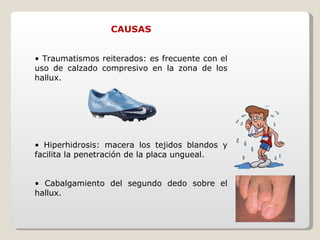 CAUSAS •  Traumatismos reiterados: es frecuente con el uso de calzado compresivo en la zona de los hallux. •  Hiperhidrosis: macera los tejidos blandos y facilita la penetración de la placa ungueal. •  Cabalgamiento del segundo dedo sobre el hallux. 