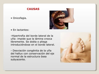 CAUSAS •  Onicofagia. •  En lactantes: Hipertrofia del borde lateral de la uña: impide que la lámina crezca libremente. Se dobla o pliega introduciéndose en el borde lateral. - Desviación congénita de la uña del hallux con conservación del eje normal de la estructura ósea subyacente. 