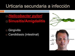 Urticaria secundaria a infección

 Helicobacter pylori
 Sinusitis/Amigdalitis


   Gingivitis
   Candidiasis (intestinal)
 