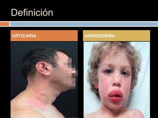 Definición

URTICARIA    ANGIOEDEMA
 