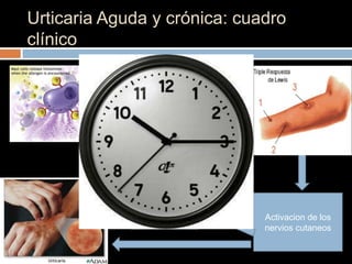 Urticaria Aguda y crónica: cuadro
clínico




              Liberacion de
              neuropeptidos   Activacion de los
                              nervios cutaneos
 