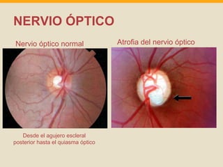 NERVIO ÓPTICO 
Nervio óptico normal Atrofia del nervio óptico 
Desde el agujero escleral 
posterior hasta el quiasma óptico 
 