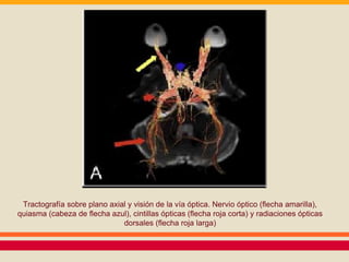 Tractografía sobre plano axial y visión de la vía óptica. Nervio óptico (flecha amarilla), 
quiasma (cabeza de flecha azul), cintillas ópticas (flecha roja corta) y radiaciones ópticas 
dorsales (flecha roja larga) 
 