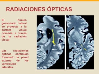 RADIACIONES ÓPTICAS 
El núcleo 
geniculado lateral 
se proyecta a la 
corteza visual 
primaria a través 
de la radiación 
visual 
Las radiaciones 
ópticas continúan 
formando la pared 
externa de los 
ventrículos 
laterales. 
 