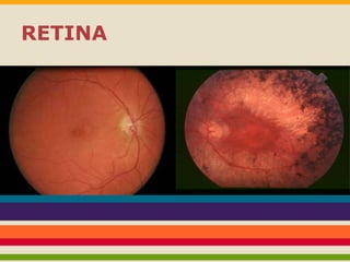 RETINA 
 