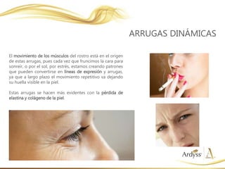 El movimiento de los músculos del rostro está en el origen
de estas arrugas, pues cada vez que fruncimos la cara para
sonreír, o por el sol, por estrés, estamos creando patrones
que pueden convertirse en líneas de expresión y arrugas,
ya que a largo plazo el movimiento repetitivo va dejando
su huella visible en la piel.
Estas arrugas se hacen más evidentes con la pérdida de
elastina y colágeno de la piel.
ARRUGAS DINÁMICAS
 