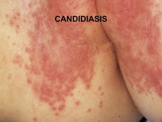 CANDIDIASIS
 