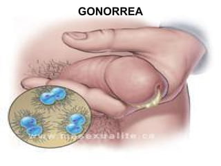 GONORREA
 