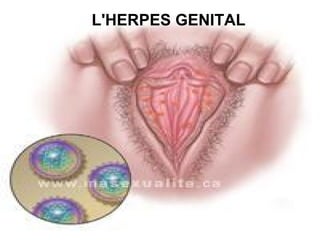 L'HERPES GENITAL
 