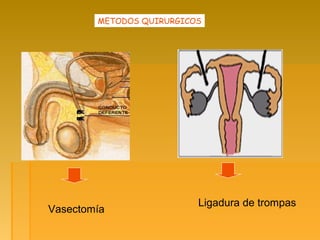 METODOS QUIRURGICOS
Vasectomía
Ligadura de trompas
 