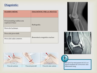 Diagnòstic:
EXAMEN MÈDIC

El traumatòleg realitza una
exploració física:

DIAGNÒSTIC PER LA IMATGE:

Radiografia.

Prova de Lachman.
Prova del pivot-shift.

Prova del calaix anterior.

Ressonància magnètica nuclear.

Davant d’un trencament de LCA, el
líquid resultant de l’artrocentesi serà
bàsicament sang.

 