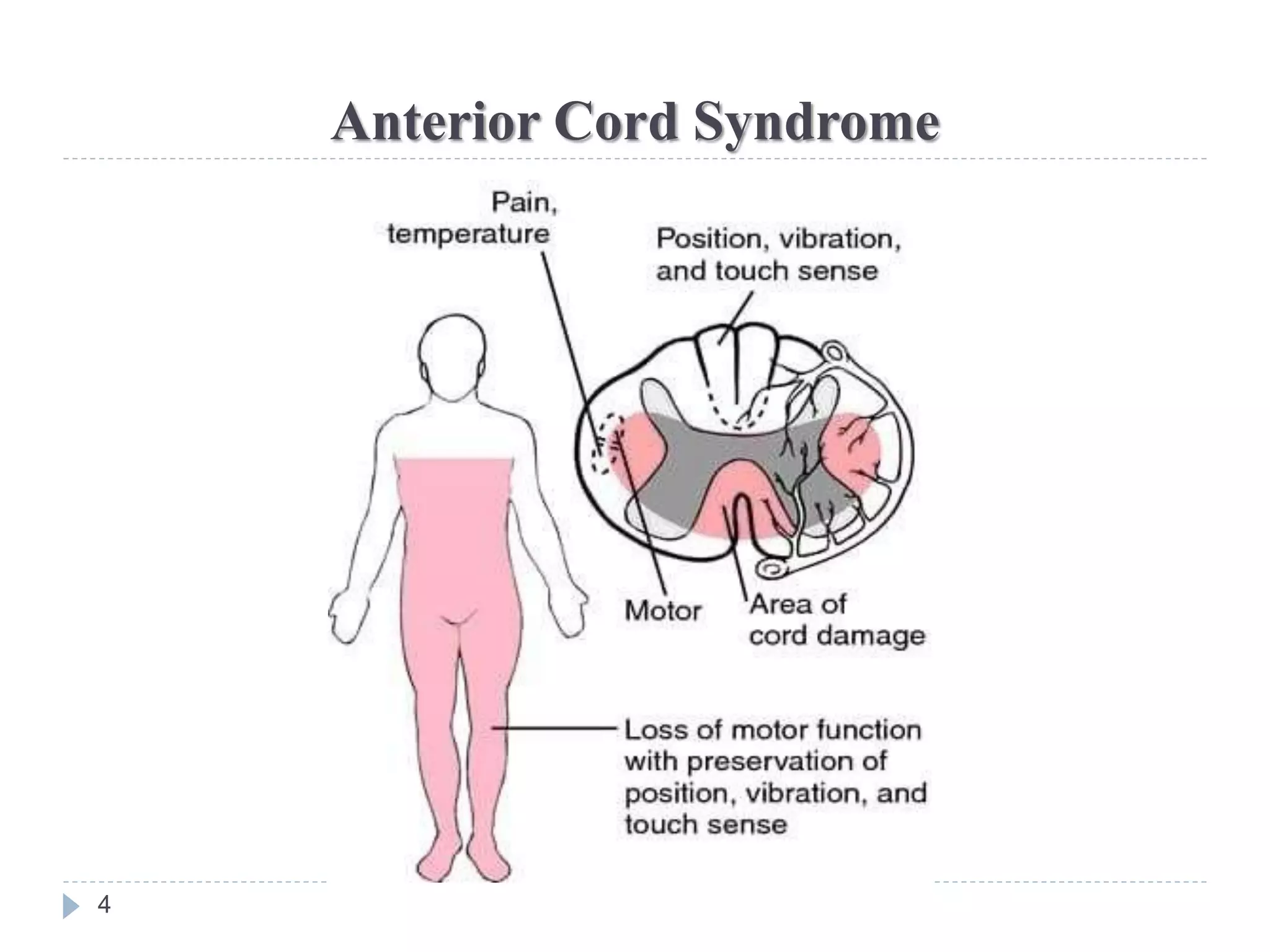 Presentaion - SCI Syndrome.pptx