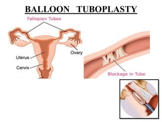 BALLOON TUBOPLASTY
 