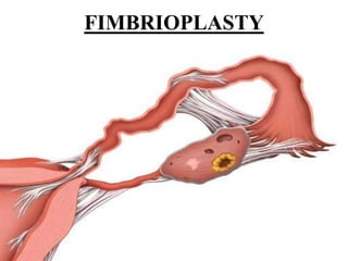 FIMBRIOPLASTY
 