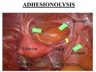 ADHESIONOLYSIS
 