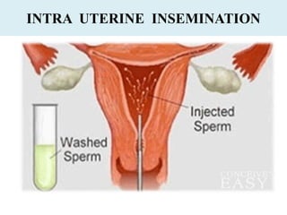 INTRA UTERINE INSEMINATION
 