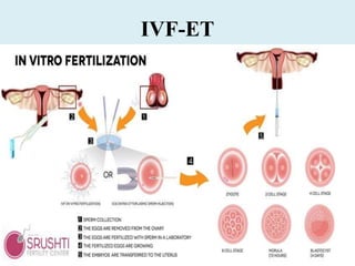 IVF-ET
 