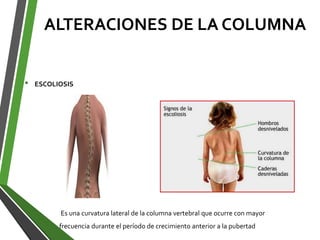 ALTERACIONES DE LA COLUMNA
• ESCOLIOSIS
Es una curvatura lateral de la columna vertebral que ocurre con mayor
frecuencia durante el período de crecimiento anterior a la pubertad
 