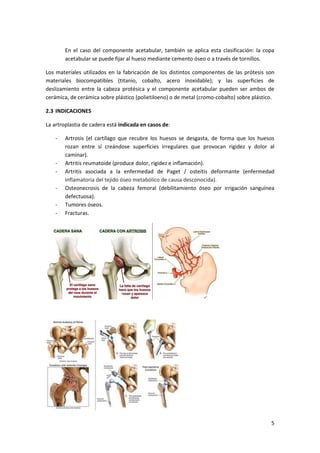 5
En el caso del componente acetabular, también se aplica esta clasificación: la copa
acetabular se puede fijar al hueso m...