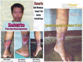 Sunarto PenderitaDiabetes 
