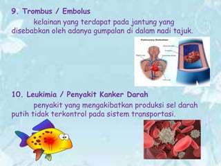 9. Trombus / Embolus
kelainan yang terdapat pada jantung yang
disebabkan oleh adanya gumpalan di dalam nadi tajuk.

10. Leukimia / Penyakit Kanker Darah
penyakit yang mengakibatkan produksi sel darah
putih tidak terkontrol pada sistem transportasi.

 