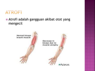  Atrofi adalah gangguan akibat otot yang
mengecil
 
