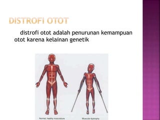 distrofi otot adalah penurunan kemampuan
otot karena kelainan genetik
 