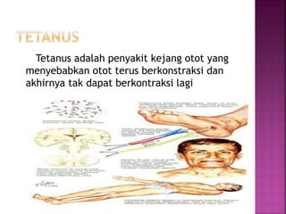 Tetanus adalah penyakit kejang otot yang
menyebabkan otot terus berkonstraksi dan
akhirnya tak dapat berkontraksi lagi
 