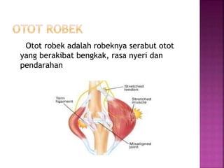 Otot robek adalah robeknya serabut otot
yang berakibat bengkak, rasa nyeri dan
pendarahan
 