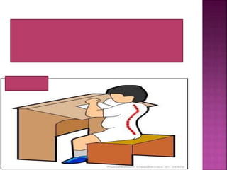 Lordosis adalah gangguan tulang belakang
melengkung ke arah dalam
 