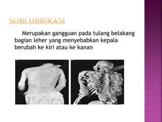 Merupakan gangguan pada tulang belakang
bagian leher yang menyebabkan kepala
berubah ke kiri atau ke kanan
 