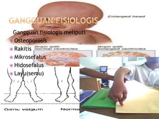 Gangguan fisiologis meliputi
 Osteoporosis
 Rakitis
 Mikrosefalus
 Hidosefalus
 Layu(semu)
 