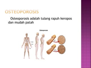 Osteoporosis adalah tulang rapuh keropos
dan mudah patah
 