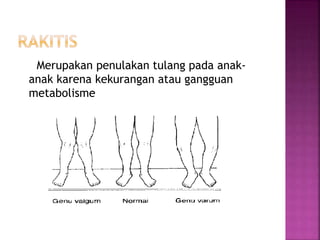 Merupakan penulakan tulang pada anak-
anak karena kekurangan atau gangguan
metabolisme
 