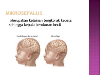 Merupakan kelainan tengkorak kepala
sehingga kepala berukuran kecil
 