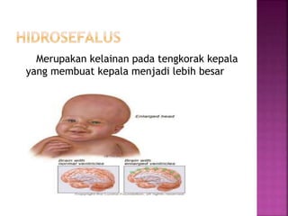 Merupakan kelainan pada tengkorak kepala
yang membuat kepala menjadi lebih besar
 