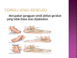 Merupakan gangguan sendi akibat gerakan
yang tidak biasa atau dipaksakan
 