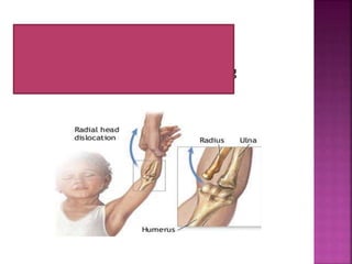 Dislokasi adalah Pergeseran tulang
penyusun sendi dari posisi normal
 