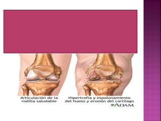 osteoartritis adalah kerusakan dan keausan
pada tulang rawan
 