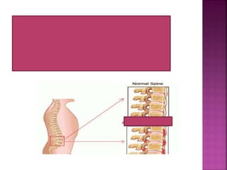 merupakan keadaan sendi tidak dapat
digerakkan dan ujung-ujung antar tulang
terasa bersatu
 