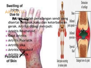 Artritis adalah peradangan sendi yang
disertai bengkak,kaku dan keterbatasan
gerak. Artritis dibagi menjadi:
 Artritis Reumatoid
 Gaut Artritis
 Artritis Psoriatik
 Artritis sika
 Artritis eksudatif
 Artritis septik
 