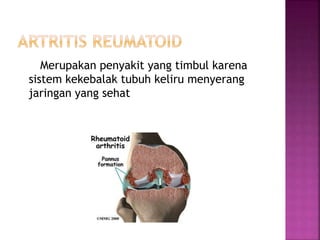 Merupakan penyakit yang timbul karena
sistem kekebalak tubuh keliru menyerang
jaringan yang sehat
 