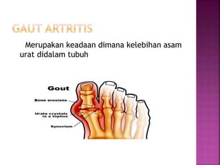 Merupakan keadaan dimana kelebihan asam
urat didalam tubuh
 