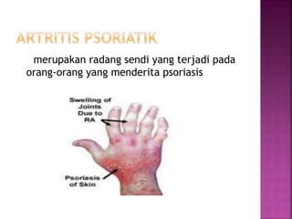 merupakan radang sendi yang terjadi pada
orang-orang yang menderita psoriasis
 