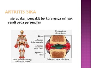Merupakan penyakit berkurangnya minyak
sendi pada persendian
 