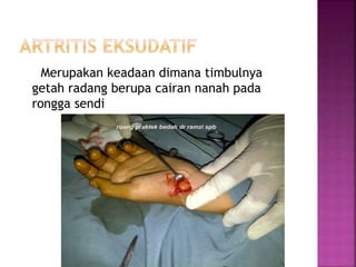 Merupakan keadaan dimana timbulnya
getah radang berupa cairan nanah pada
rongga sendi
 