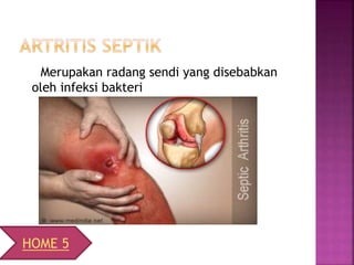 Merupakan radang sendi yang disebabkan
oleh infeksi bakteri
HOME 5
 